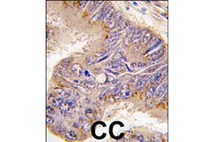 Formalin-fixed and paraffin-embedded human colon carcinoma tissue reacted with RPS6 polyclonal antibody  , which was peroxidase-conjugated to the secondary antibody, followed by DAB staining. (RPS6 Antikörper  (N-Term))