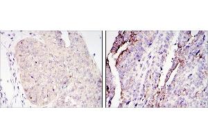 Immunohistochemical analysis of paraffin-embedded ovary tumour tissues (left) and lung cancer (right) using CRTC2 antibody with DAB staining. (CRTC2 Antikörper)
