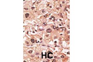 Formalin-fixed and paraffin-embedded human hepatocellular carcinoma tissue reacted with MAGEF1 polyclonal antibody  , which was peroxidase-conjugated to the secondary antibody, followed by AEC staining. (MAGEF1 Antikörper  (C-Term))