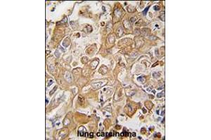 Formalin-fixed and paraffin-embedded human lung carcinoma tissue reacted with LECT1 antibody , which was peroxidase-conjugated to the secondary antibody, followed by DAB staining.