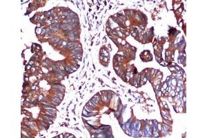 Immunohistochemical analysis of paraffin-embedded Colorectal cancer using BiP/GRP78 (C-terminus) Mouse mAb (1/100 dilution). (GRP78 Antikörper  (C-Term))
