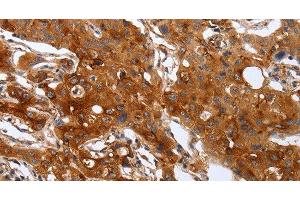 Immunohistochemistry of paraffin-embedded Human lung cancer using PLAUR Polyclonal Antibody at dilution of 1:60 (PLAUR Antikörper)