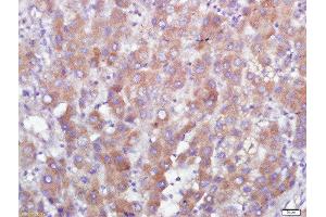 Paraformaldehyde-fixed, paraffin embedded human liver carcinoma tissue, Antigen retrieval by boiling in sodium citrate buffer(pH6) for 15min, Block endogenous peroxidase by 3% hydrogen peroxide for 30 minutes, Blocking buffer (normal goat serum) at 37°C for 20min, Antibody incubation with GPR110 Polyclonal Antibody, Unconjugated  at 1:500 overnight at 4°C, followed by a conjugated secondary and DAB staining (G Protein-Coupled Receptor 110 Antikörper  (AA 51-150))