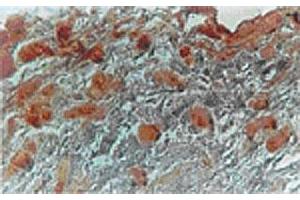 Immunhistochemical analysis in adipocytes of human breast carcinoma tissue using MKI67IP polyclonal antibody  at 1 : 500 dilution. (NIFK Antikörper  (AA 144-160))
