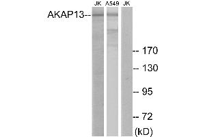 Immunohistochemistry analysis of paraffin-embedded human lung carcinoma tissue using AKAP13 antibody. (AKAP13 Antikörper)
