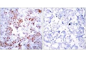 Immunohistochemistry analysis of paraffin-embedded human breast carcinoma tissue, using ATF2 (Ab-69 or 51) Antibody. (ATF2 Antikörper  (AA 35-84))