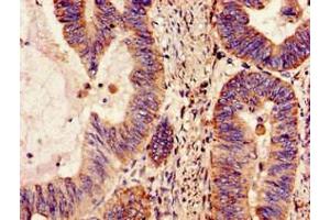 Immunohistochemistry of paraffin-embedded human colon cancer using ABIN7160959 at dilution of 1:100 (NDUFS4 Antikörper  (AA 43-161))