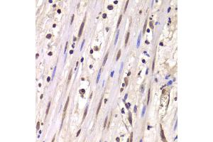 Immunohistochemistry of paraffin-embedded human mammary cancer using LSM4 antibody (ABIN1980258) at dilution of 1:100 (40x lens). (LSM4 Antikörper)