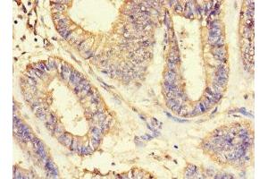 Immunohistochemistry of paraffin-embedded human endometrial cancer using ABIN7143597 at dilution of 1:100 (ASIP Antikörper  (AA 23-112))