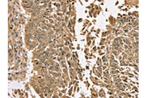 The image on the left is immunohistochemistry of paraffin-embedded Human lung cancer tissue using (TGM6 Antibody) at dilution 1/35, on the right is treated with synthetic peptide. (TGM6 Antikörper)