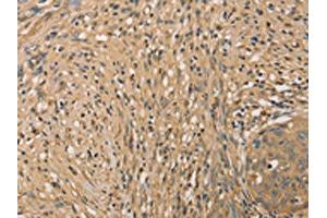 The image on the left is immunohistochemistry of paraffin-embedded Human cervical cancer tissue using ABIN7131042(SETD2 Antibody) at dilution 1/40, on the right is treated with fusion protein. (SETD2 Antikörper)