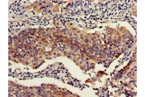 Immunohistochemistry of paraffin-embedded human cervical cancer using ABIN7151111 at dilution of 1:100 (RBBP6 Antikörper  (AA 51-97))