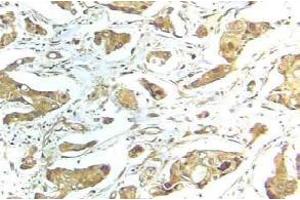 Immunohistochemistry (IHC) analyzes of STAT1 antibody in paraffin-embedded human breast carcinoma tissue. (STAT1 Antikörper)