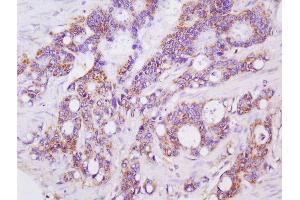 Formalin-fixed and paraffin embedded human colon carcinoma labeled with Anti-LGALS3BP Polyclonal Antibody, Unconjugated  at 1:200 followed by conjugation to the secondary antibody and DAB staining (LGALS3BP Antikörper  (AA 301-400))