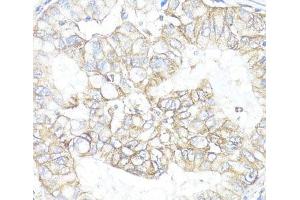 Immunohistochemistry of paraffin-embedded Human lung cancer using ATP1B1 Polyclonal Antibody at dilution of 1:100 (40x lens). (ATP1B1 Antikörper)