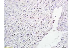 Formalin-fixed and paraffin embedded human endometrial cancer labeled with Anti-Notch1/MOTC Polyclonal Antibody, Unconjugated (ABIN675114) followed by conjugation to the secondary antibody and DAB staining (Notch1 Antikörper  (AA 2101-2300))