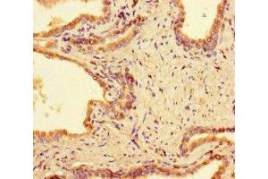 Immunohistochemistry of paraffin-embedded human prostate cancer using ABIN7165948 at dilution of 1:100 (PPM1H Antikörper  (AA 73-289))