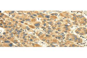 Immunohistochemistry of paraffin-embedded Human liver cancer tissue using UACA Polyclonal Antibody at dilution 1:45 (UACA Antikörper)