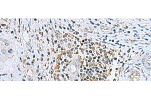Immunohistochemistry of paraffin-embedded Human liver cancer tissue using DHRS7B Polyclonal Antibody at dilution of 1:80(x200) (DHRS7B Antikörper)