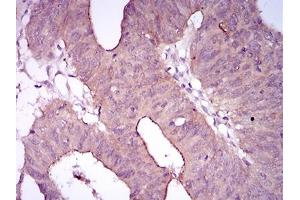 Immunohistochemical analysis of paraffin-embedded rectum cancer tissues using ITGA2B mouse mAb with DAB staining.
