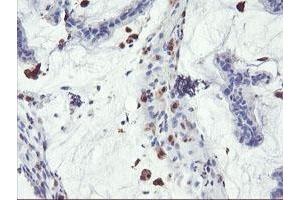Immunohistochemical staining of paraffin-embedded Adenocarcinoma of Human colon tissue using anti-SDS mouse monoclonal antibody. (serine Dehydratase Antikörper)