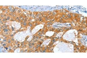 Immunohistochemistry of paraffin-embedded Human cervical cancer tissue using AMHR2 Polyclonal Antibody at dilution 1:40 (AMHR2 Antikörper)