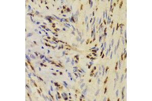 Immunohistochemistry of paraffin-embedded Human adenomyosis using XRCC5 antibody at dilution of 1:100 (40x lens).
