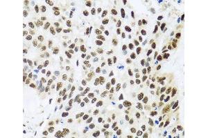 Immunohistochemistry of paraffin-embedded Human lung cancer using FUBP1 Polyclonal Antibody at dilution of 1:100 (40x lens). (FUBP1 Antikörper)