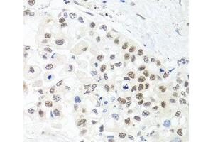 Immunohistochemistry of paraffin-embedded Human lung cancer using TRMT1 Polyclonal Antibody at dilution of 1:100 (40x lens). (TRMT1 Antikörper)
