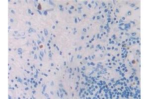 Detection of MIP4a in Human Lung cancer Tissue using Polyclonal Antibody to Macrophage Inflammatory Protein 4 Alpha (MIP4a) (CCL26 Antikörper  (AA 24-94))