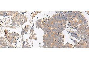 Immunohistochemistry of paraffin-embedded Human lung cancer tissue using GPR153 Polyclonal Antibody at dilution of 1:40(x200) (GPR153 Antikörper)