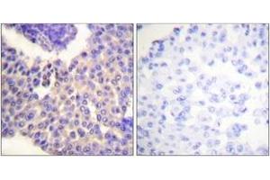 Immunohistochemistry analysis of paraffin-embedded human breast carcinoma, using Arrestin 1 (Phospho-Ser412) Antibody. (SAG Antikörper  (pSer412))