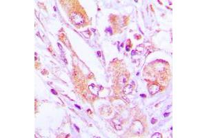 Immunohistochemical analysis of MRPS35 staining in human lung cancer formalin fixed paraffin embedded tissue section.