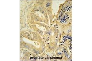 TLL1 antibody (C-term) (ABIN654712 and ABIN2844401) immunohistochemistry analysis in formalin fixed and paraffin embedded human prostate carcinoma followed by peroxidase conjugation of the secondary antibody and DAB staining.