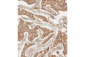 Immunohistochemical analysis of paraffin-embedded Human breast carcinoma tissue using (ABIN388039 and ABIN2845540) performed on the Leica® BOND RXm. (Ubiquitin Antikörper  (N-Term))