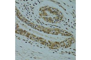 Immunohistochemistry of paraffin-embedded human breast cancer using RSRC1 antibody (ABIN5974341) at dilution of 1/100 (40x lens). (RSRC1 Antikörper)