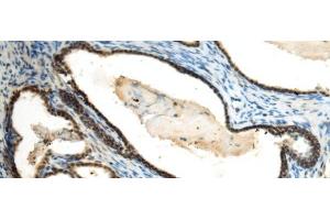 Immunohistochemistry of paraffin-embedded Human prost at e cancer tissue using SUV39H2 Polyclonal Antibody at dilution of 1:70(x200) (SUV39H2 Antikörper)