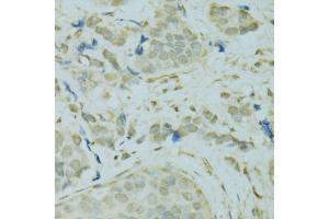 Immunohistochemistry of paraffin-embedded human breast cancer using SAFB antibody (ABIN5975793) at dilution of 1/100 (40x lens). (SAFB Antikörper)