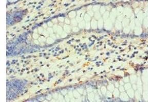 Immunohistochemistry of paraffin-embedded human colon cancer using ABIN7155678 at dilution of 1:100 (DLX3 Antikörper  (AA 1-120))
