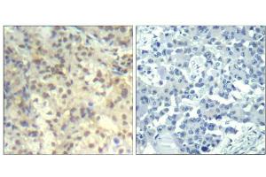 Immunohistochemical analysis of paraffin-embedded human lung carcinoma tissue using cofilin1 (phospho-Tyr139) Antibody (E011506). (Cofilin Antikörper  (pTyr139))