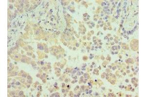 Immunohistochemistry of paraffin-embedded human lung cancer using ABIN7154967 at dilution of 1:100 (N6AMT1 Antikörper  (AA 1-186))