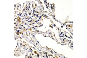 Immunohistochemistry of paraffin-embedded human lung cancer using WNT3A antibody at dilution of 1:200 (400x lens). (WNT3A Antikörper)