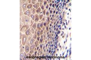 CCDC97 Antibody (C-term) immunohistochemistry analysis in formalin fixed and paraffin embedded human esophageal carcinoma followed by peroxidase conjugation of the secondary antibody and DAB staining. (CCDC97 Antikörper  (C-Term))