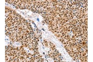 The image on the left is immunohistochemistry of paraffin-embedded Human lung cancer tissue using ABIN7129916(IRF6 Antibody) at dilution 1/50, on the right is treated with fusion protein. (IRF6 Antikörper)