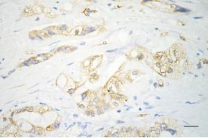 Immunohistochemistry was performed on paraffin-embedded human pancreatic adenocarcinoma using sonic hedgehog antibody (ABIN7800969), 1:200). (Rekombinanter Sonic Hedgehog Signaling Molecule Antikörper)