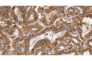 Immunohistochemistry of paraffin-embedded Human thyroid cancer using PPOX Polyclonal Antibody at dilution of 1:40 (PPOX Antikörper)