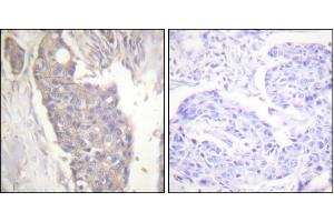 Immunohistochemistry analysis of paraffin-embedded human breast carcinoma tissue using Fas antibody. (FAS Antikörper)
