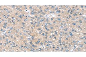 Immunohistochemistry of paraffin-embedded Human liver cancer using SLIT2 Polyclonal Antibody at dilution of 1:30