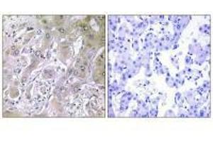 Immunohistochemistry analysis of paraffin-embedded human liver carcinoma tissue using ACOT12 antibody. (ACOT12 Antikörper)