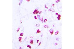 Immunohistochemical analysis of C/EBP delta/epsilon staining in human lung cancer formalin fixed paraffin embedded tissue section. (C/EBP delta/epsilon (C-Term) Antikörper)